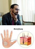 Փսորիազը չի՞ խանգարում